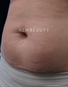 Dr. Ruth Hillelson Skin Resurfacing - Before