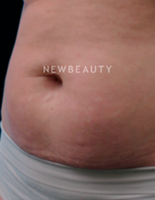 Dr. Ruth Hillelson Skin Resurfacing - Before