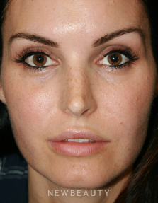 Dr. John Kang - Fat Transfer - After