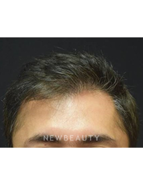 Dr. Jeffrey B. Wise - Hair Loss Treatment - After