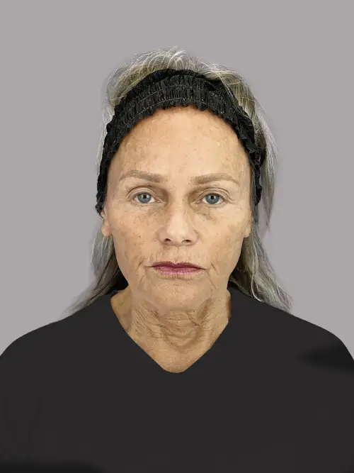 Dr. Sheila Barbarino-Laser-54798830 - Before