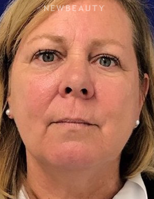 Dr. Dilip Madnani – Liquid Facelift - After