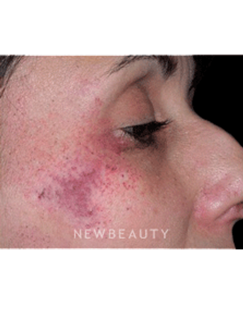 Dr. Marina Peredo Elos Lasers - Before