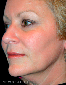 Dr. Kelly Bomer Liquid Facelift - After