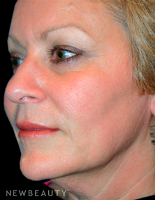 Dr. Kelly Bomer Liquid Facelift - After