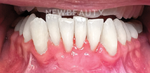Dr. Hamid Atabakhsh – Smile Makeover - 46510405 - After