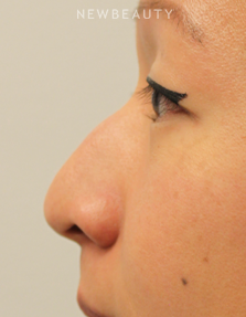 Dr. Kimberly Lee - Non-Surgical Rhinoplasty - Before