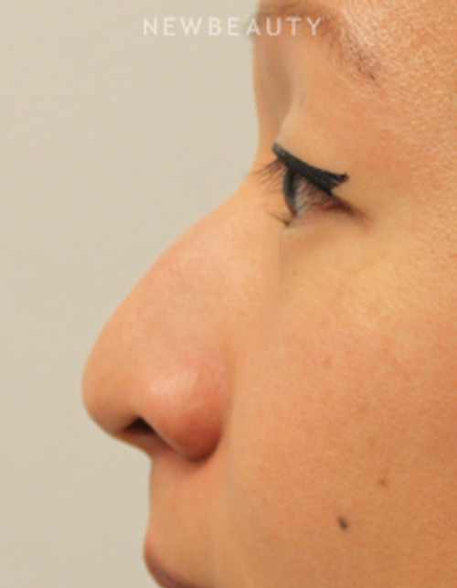 Dr. Kimberly Lee - Non-Surgical Rhinoplasty - Before