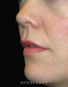 Dr. Jody Levine - Lip Enhancement - After