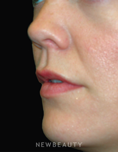 Dr. Jody Levine - Lip Enhancement - After