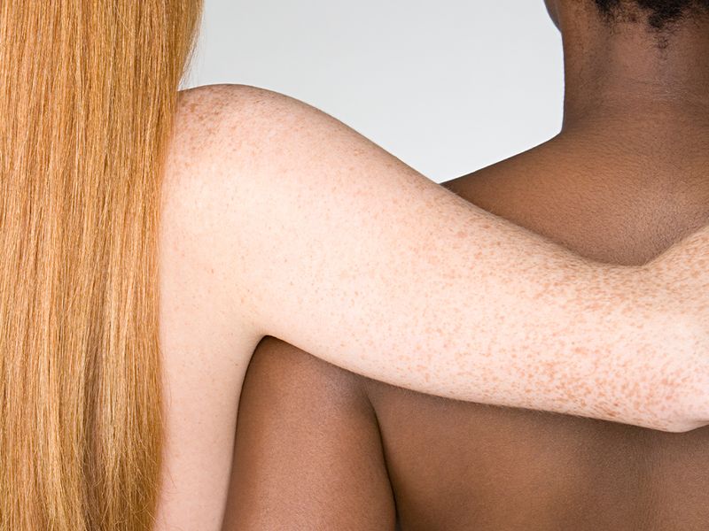 How the Conversation on Treating Skin of Color Is Changing