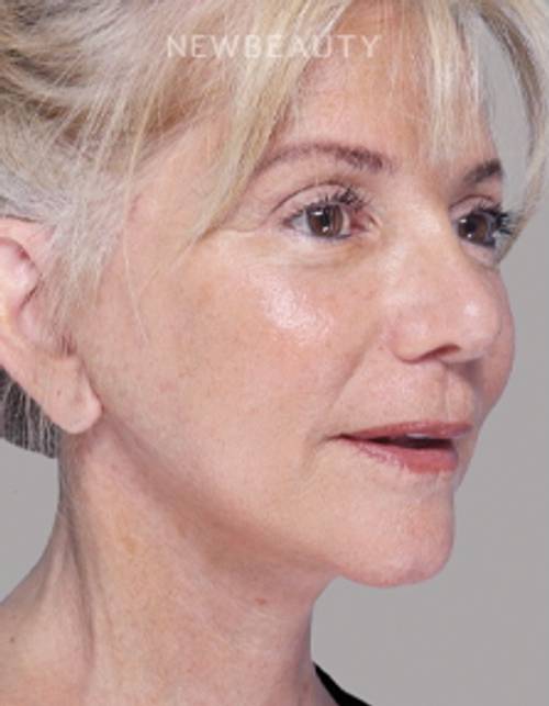 Dr. Paul Nassif - Facelift, Necklift & Browlift - 51350914 - After