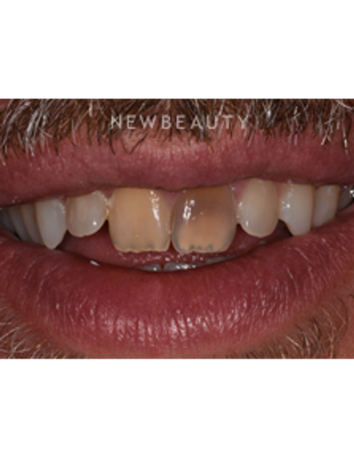 Dr. Sara Cummins - Smile Makeover - Before