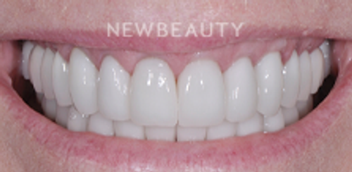 Dr. Salvator La Mastra - Smile Makeover -46107993 - After