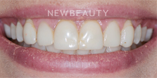 Dr. Nathan Hoffman - Teeth Whitening & Veneers - Before