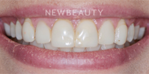 Dr. Nathan Hoffman - Teeth Whitening & Veneers - Before