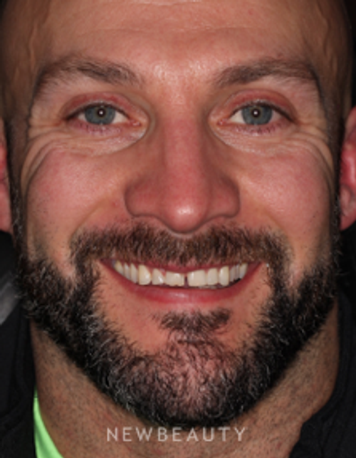Dr. Neal Patel - Veneers - Before