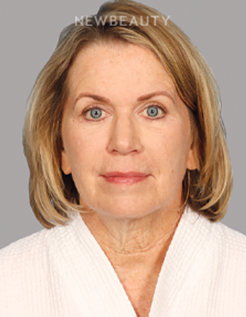 Dr. Mahabir – Upper Blepharoplasty – 20637850 - After