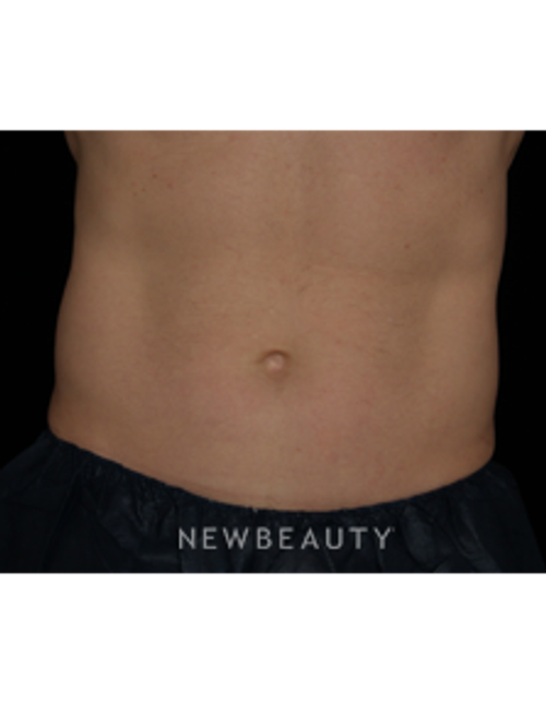 Dr. Jennifer Segal - CoolSculpting - After