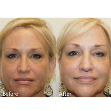 Microneedling before and after Image / Schlessinger