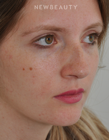 Dr. Edward Kwak - Rhinoplasty - Before
