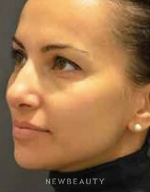 Dr. Aviva Preminger - Rhinoplasty - After