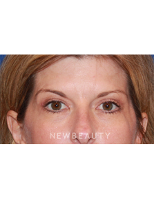 Dr. Dilip D. Madnani - Eyelift - After