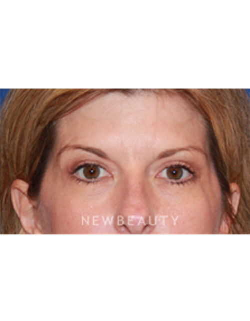 Dr. Dilip D. Madnani - Eyelift - After