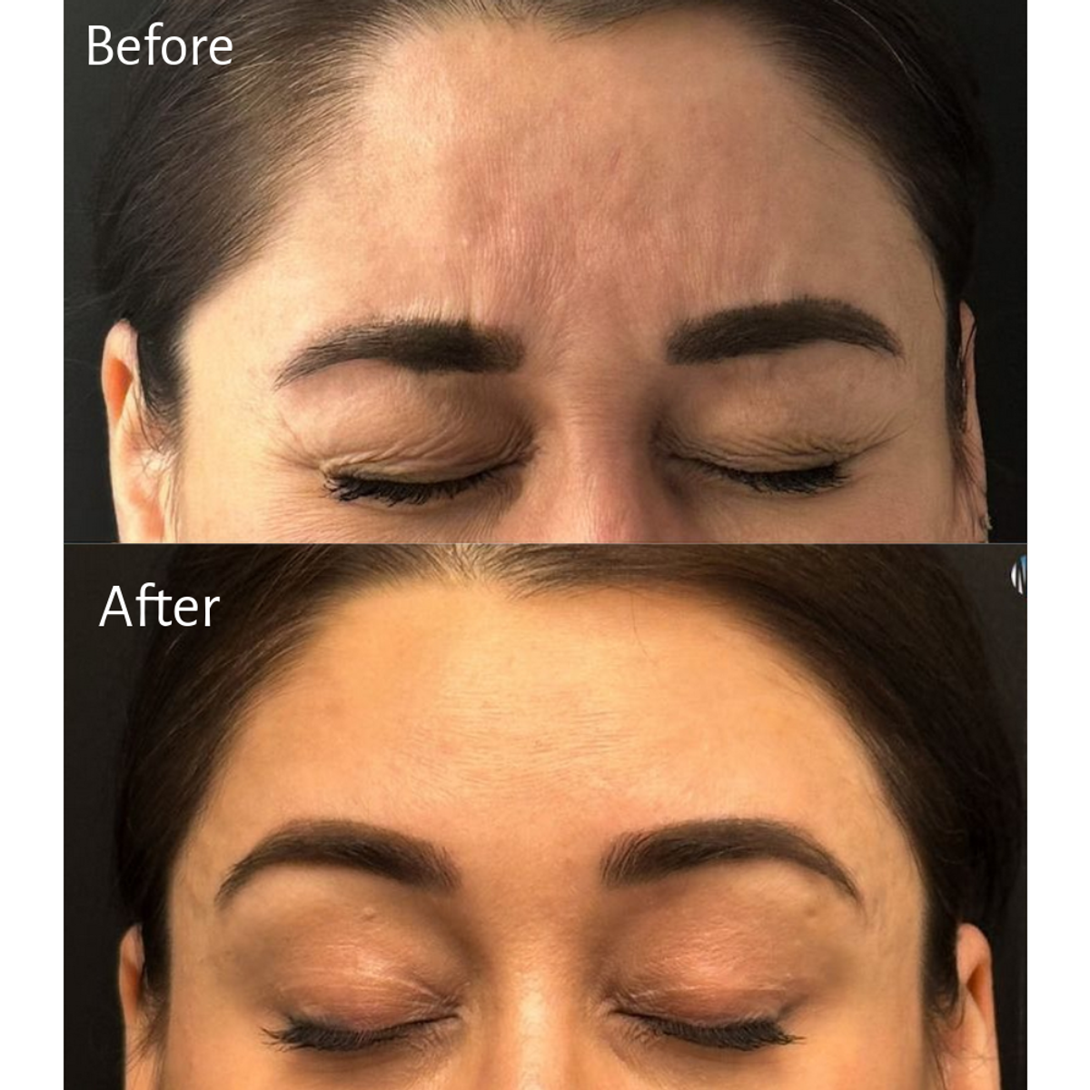 Dr. Matthew J. Elias & Dr. Merrick D. Elias Treatment: Botox