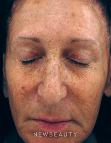 Dr. Kenneth Beer IPL Laser - Before