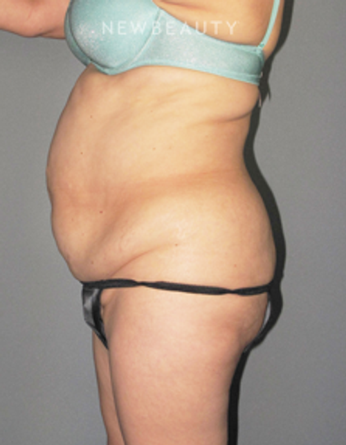 Dr. German Newall - Shapely Restoration - Before