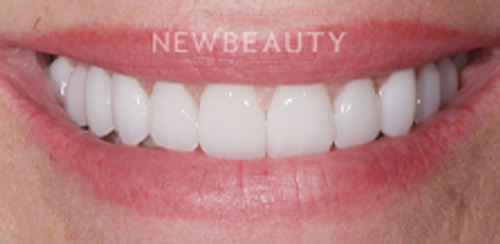 Dr. Salvator La Mastra - Smile Makeover -46107438 - After