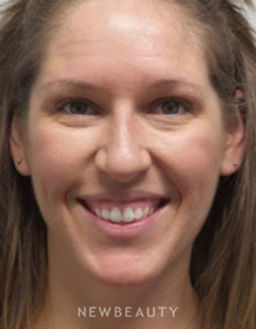 Dr. Marina Peredo - Botox - Before
