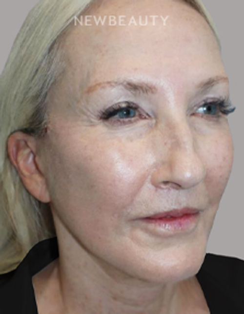 Dr. Sanjay Grover - Facelift - 49726292 - After