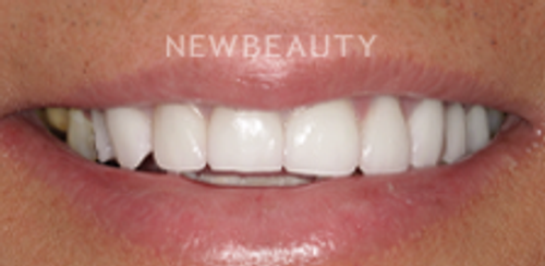 Dr. Salvator La Mastra - Smile Makeover -46106837 - Before