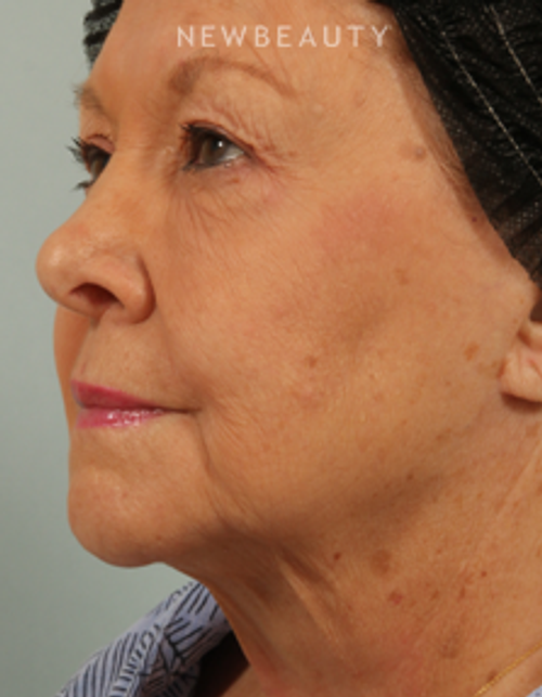 Dr. Kenneth Beer - CoolSculpting - After