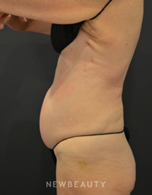 Dr. Aviva Preminger - CoolSculpting - Before