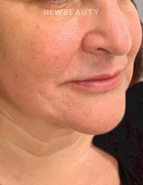 Dr. Doris Day - Facial Rejuvenation - After