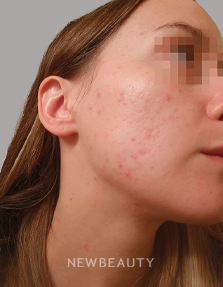 Dr. Anna Chacon - Acne - 34291048 - After