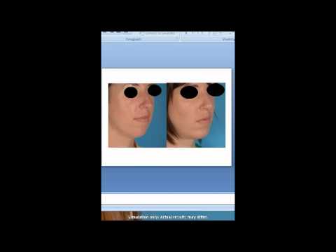 Dr. David Kim – Chin Augmentation In 15 Minutes