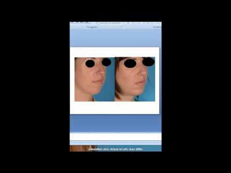 Dr. David Kim – Chin Augmentation In 15 Minutes