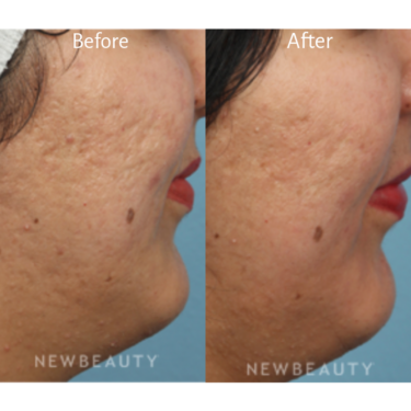 Microneedling before and after Image / Kathleen Behr