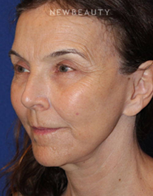 Dr. Dilip Madnani - Facelift & Necklift - After