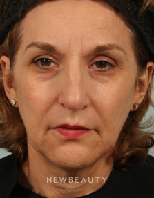 Dr. Kenneth R. Beer - Natural-Looking Fullness - Before