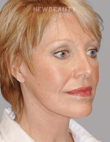 Dr. E. Gaylon McCollough - Refreshed and Renewed - 44692654 - After