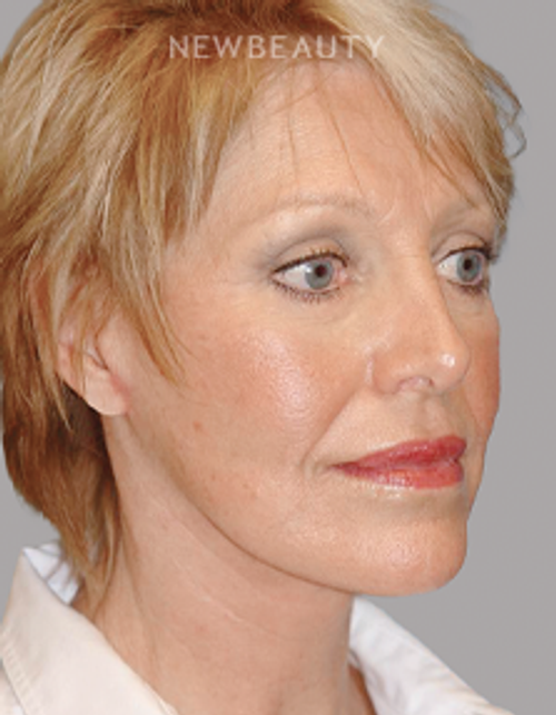 Dr. E. Gaylon McCollough - Refreshed and Renewed - 44692654 - After