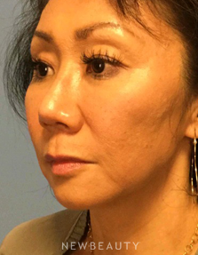 Dr. Henry Mentz - Limited Incision Facelift - After