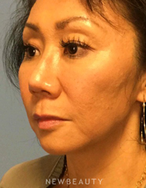 Dr. Henry Mentz - Limited Incision Facelift - After