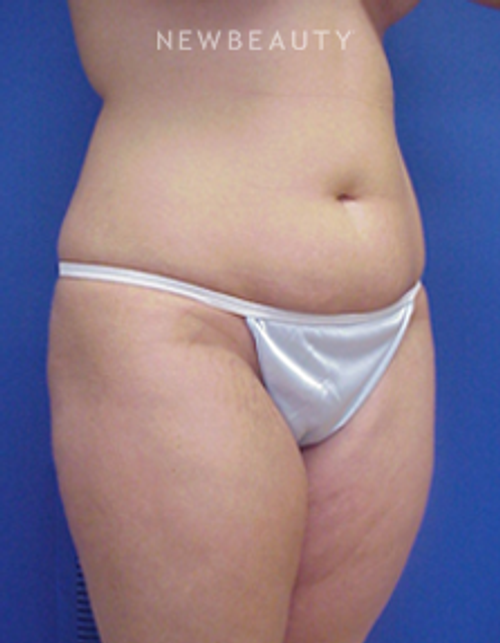 Dr. Joseph Russo - Fit and Trim Results - Before