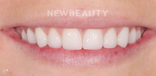 Dr. Salvator La Mastra - Smile Makeover -46106746 - After